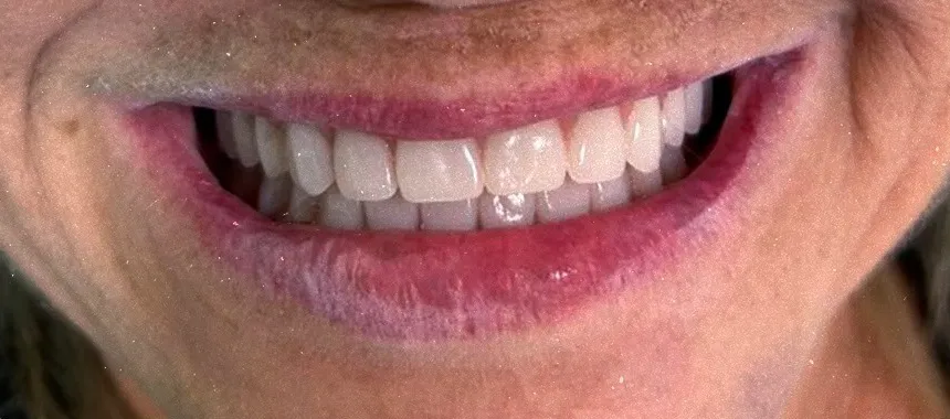Sorriso de paciente após implante com carga imediata na Sorria Feital