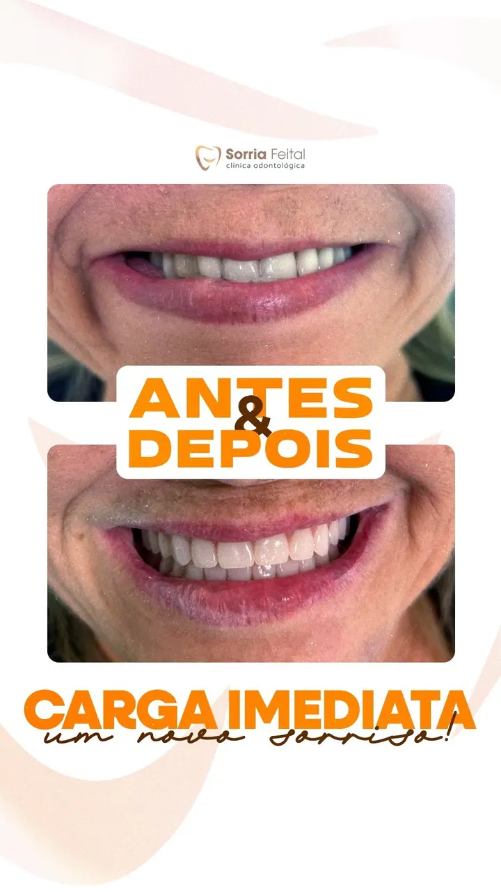 Antes e depois de implante com carga imediata na Sorria Feital