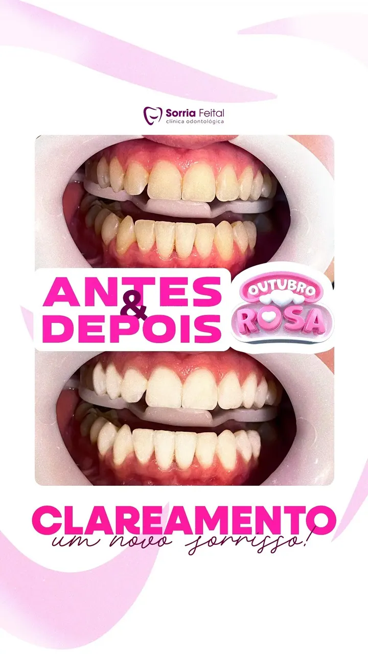 Antes e depois de clareamento dental na Sorria Feital