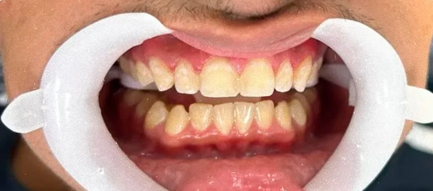 Antes — Facetas dentárias, caso real da Sorria Feital