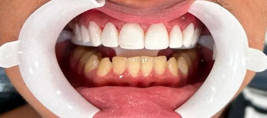 Depois — Facetas dentárias, caso real da Sorria Feital