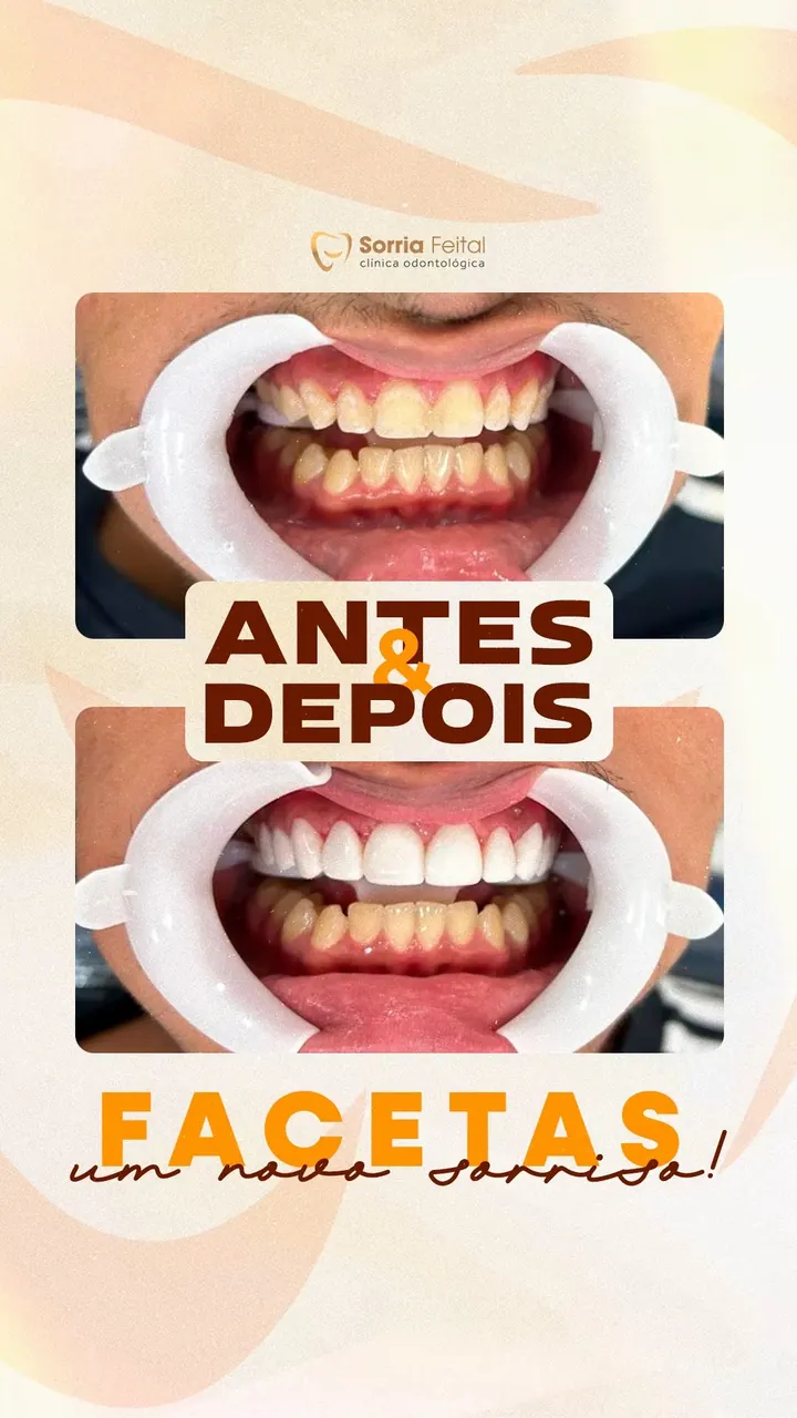 Antes e depois de facetas na Sorria Feital