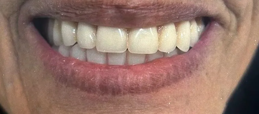 Sorriso de paciente após troca de prótese inferior com carga imediata na Sorria Feital