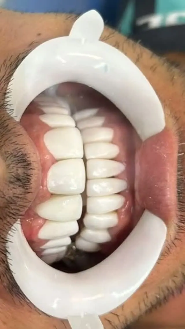 Resultado de facetas feitas pela Dra. Carolina Castilho na Sorria Feital, com afastador labial