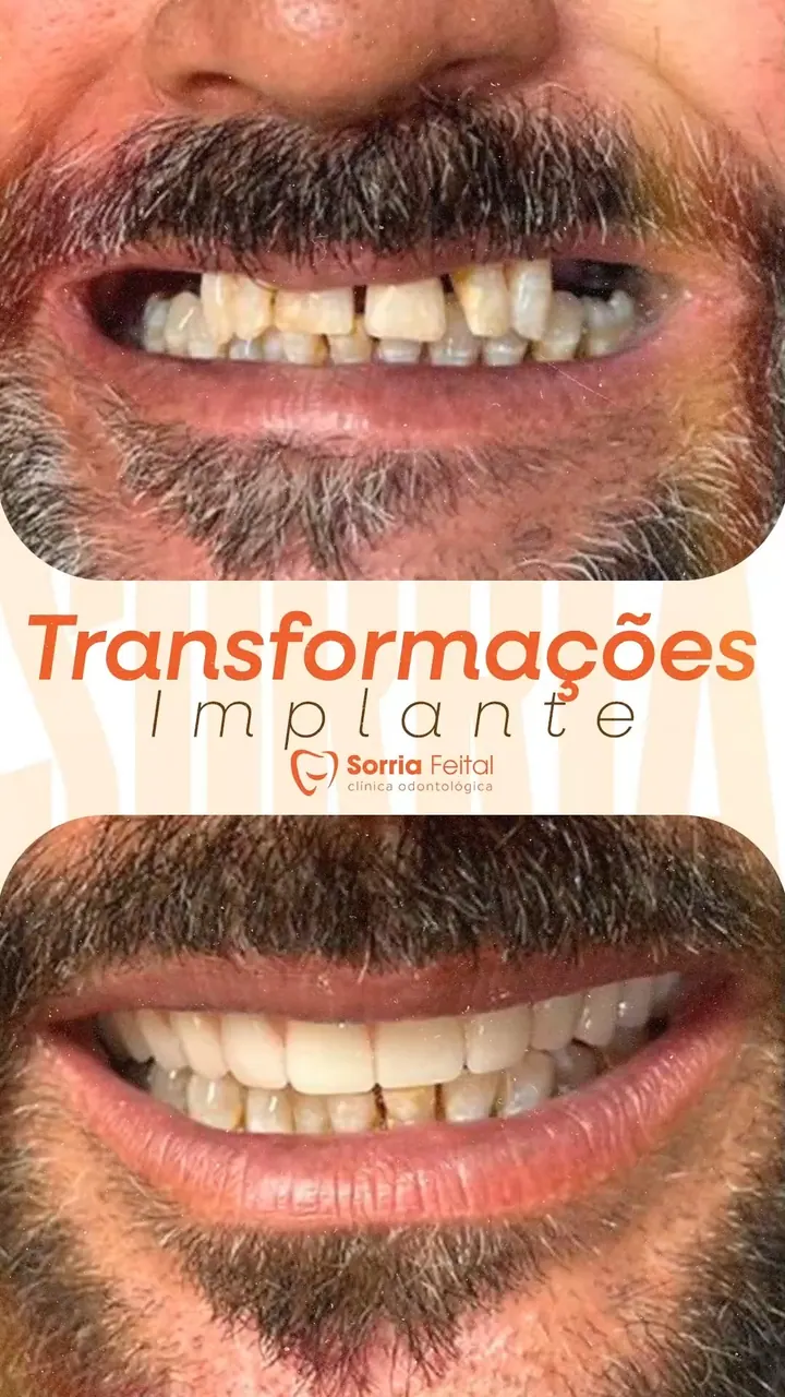 Transformação com implante dentário: sorriso antes e depois